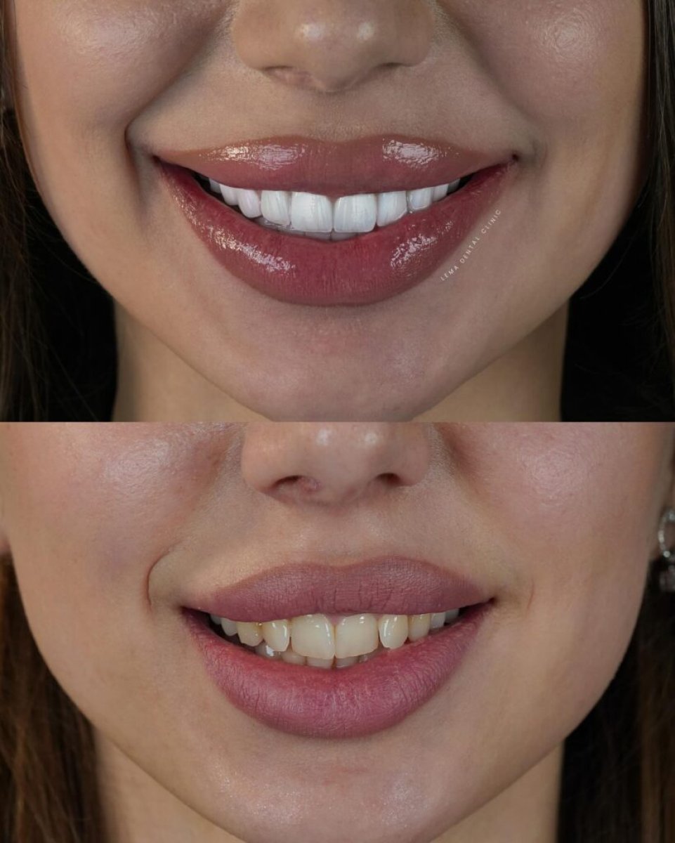 Before and after Emax veneers result, smile transformation at Lema Dental Clinic