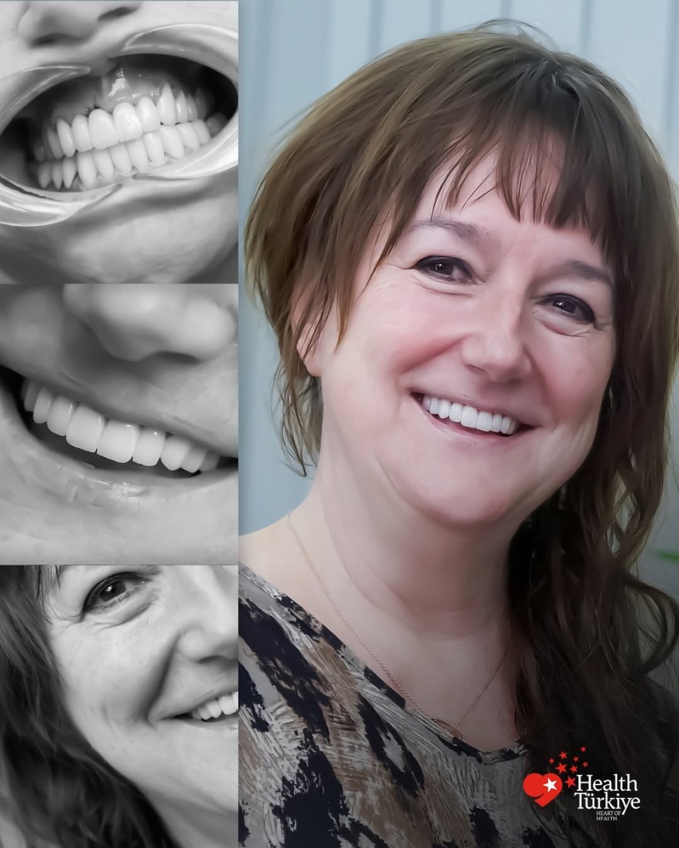 Emax veneers before and after results at Health Turkiye clinic – smile makeover transformation