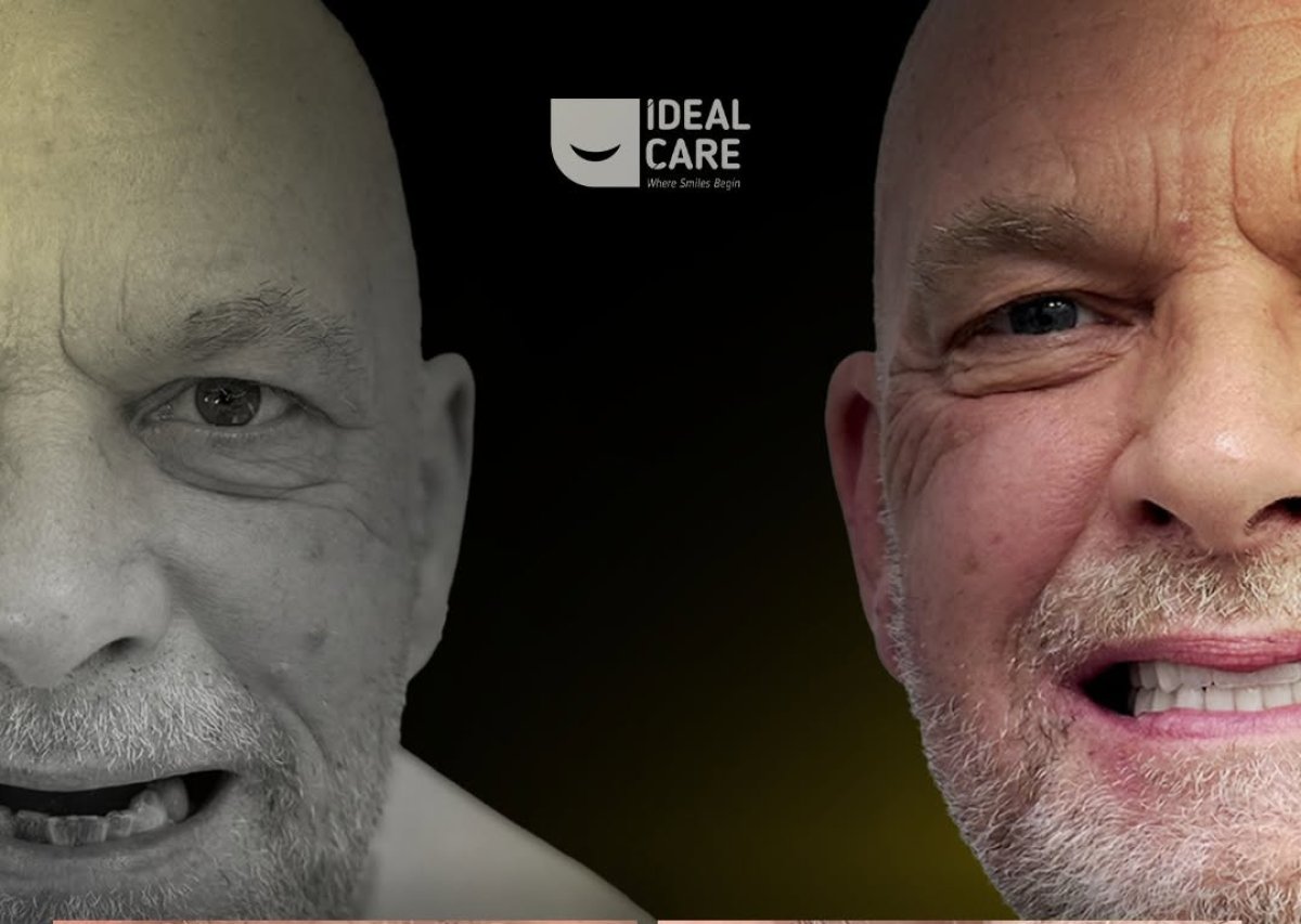 Before and after All-on-4 dental implants result at Ideal Care Clinic – restored smile