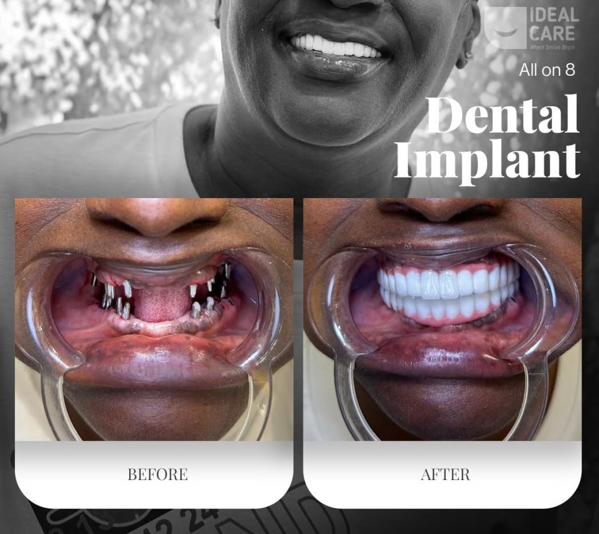 Before and after dental implant All-on-8 results at Ideal Care Clinic, full smile restoration