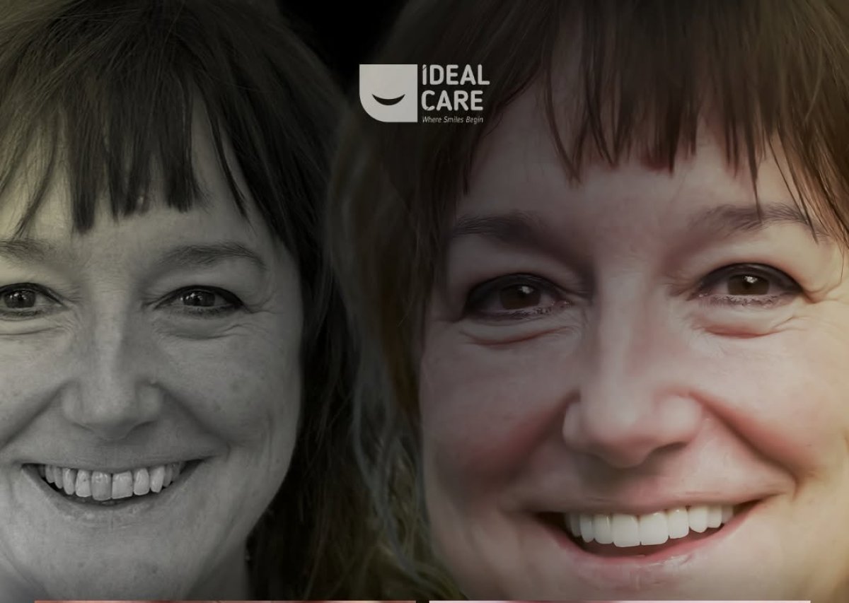 Resultado de blanqueamiento dental antes y después en Ideal Care: sonrisa más brillante
