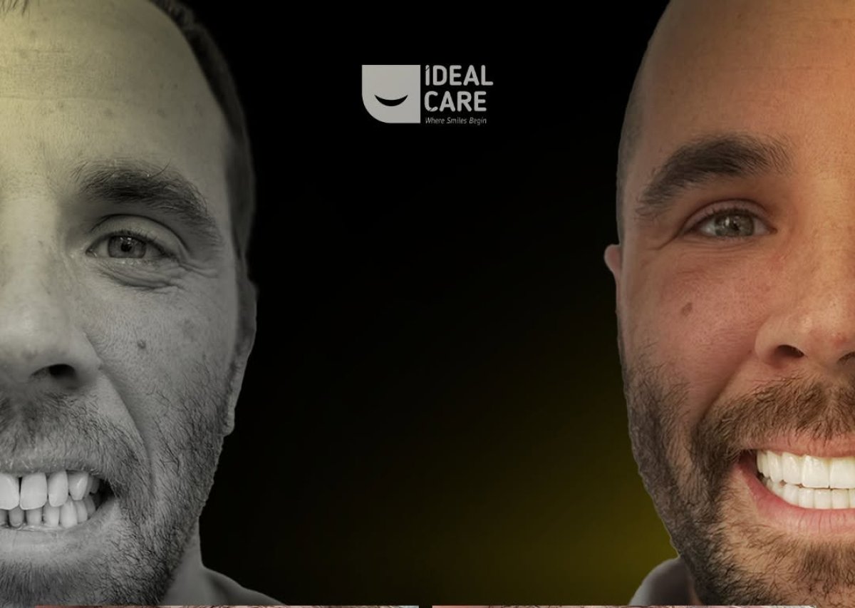 Resultados de blanqueamiento dental antes y después en Ideal Care – sonrisa más blanca