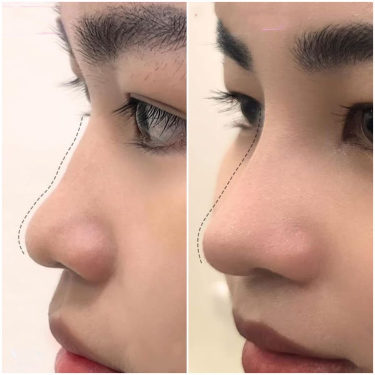 Resultados antes y después de rinoplastia de punta en Somchai Clinic, contorno mejorado