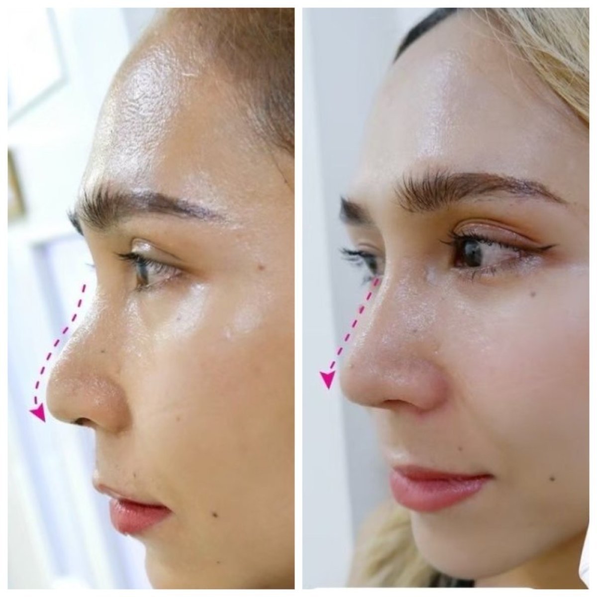 Resultados antes y después de rinoplastia de punta en Somchai Clinic, mejora de forma nasal