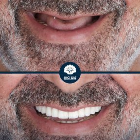 All-on-6 Dental Implants with Straumann Implants - photo 5