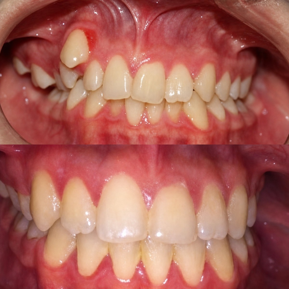 Antes y después de extrusión ortodóntica en KLİNİKEN: mejora en alineación dental