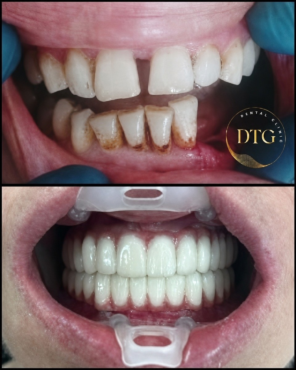 Smile makeover before and after results with dental veneers at DTG clinic – whiter teeth