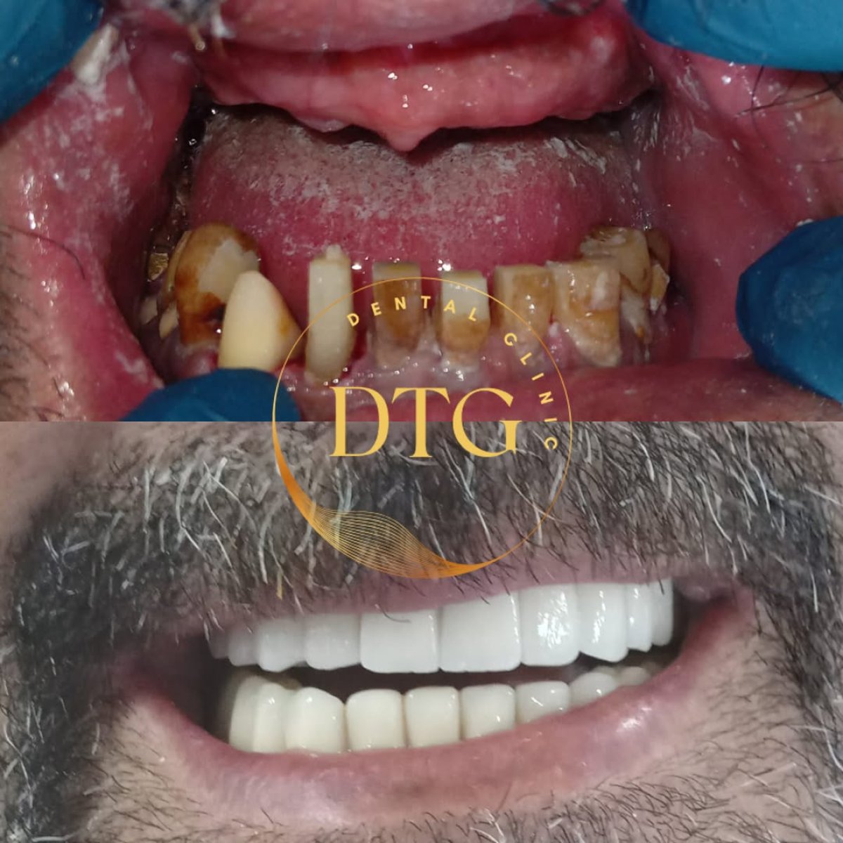 نتائج قبل وبعد تجميل الابتسامة في DTG Dental Clinic – استعادة الأسنان البيضاء