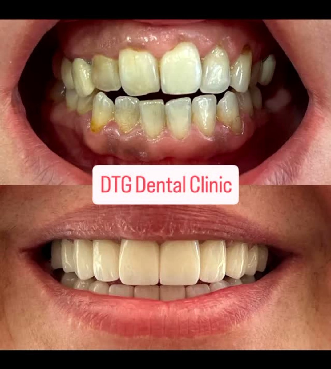 Результаты до и после улыбки в DTG Dental Clinic – улучшено выравнивание зубов