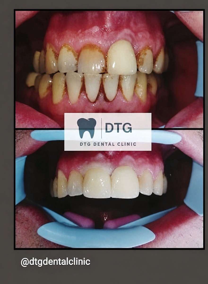 Résultats avant et après blanchiment dentaire au laser chez DTG Dental Clinic – sourire plus blanc