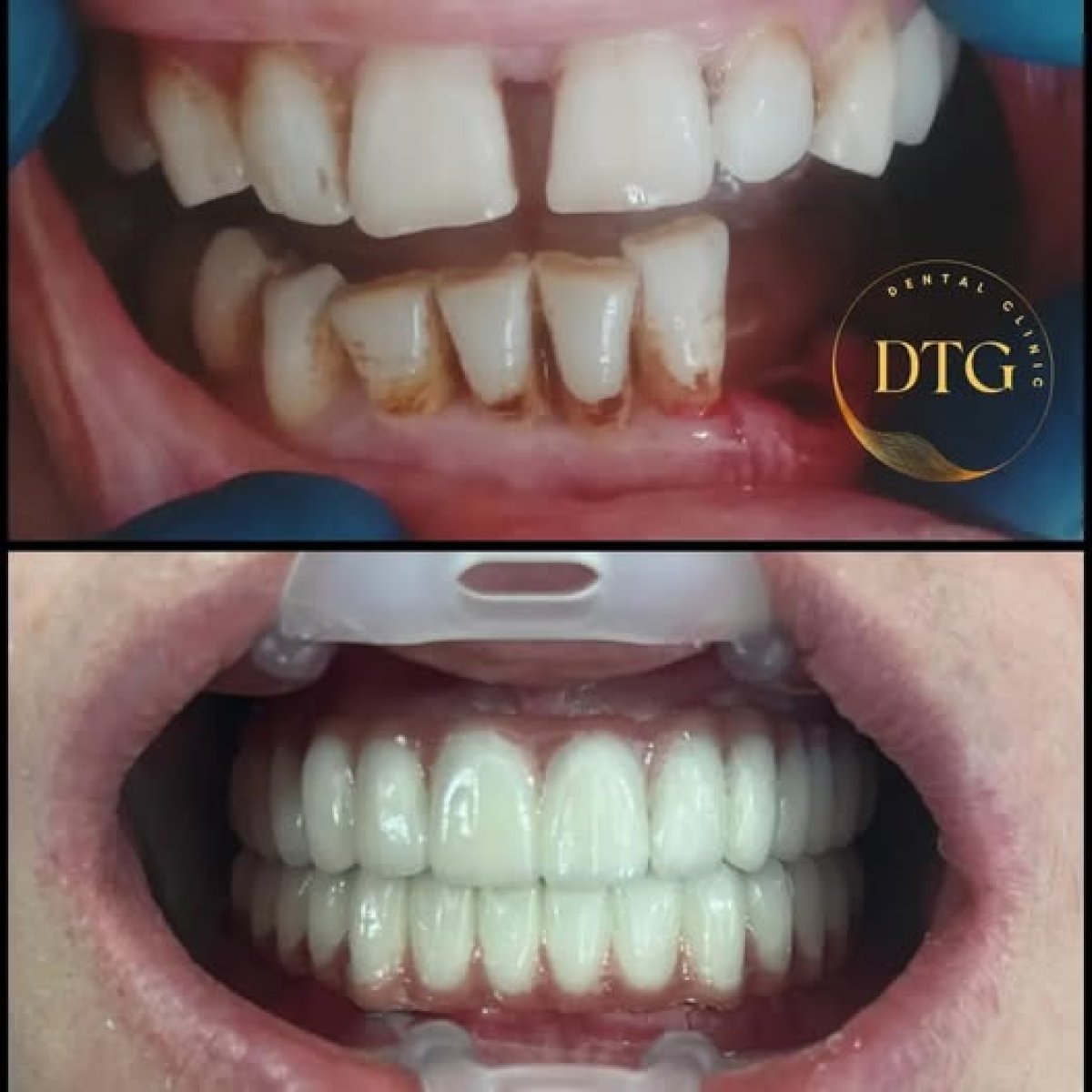 Résultat avant/après restauration dentaire à DTG Clinic – sourire amélioré et dents blanches