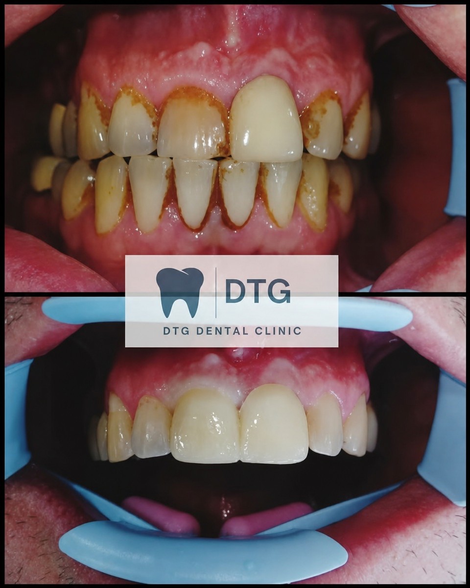Before and after tooth whitening results at DTG Dental Clinic – visibly brighter smile