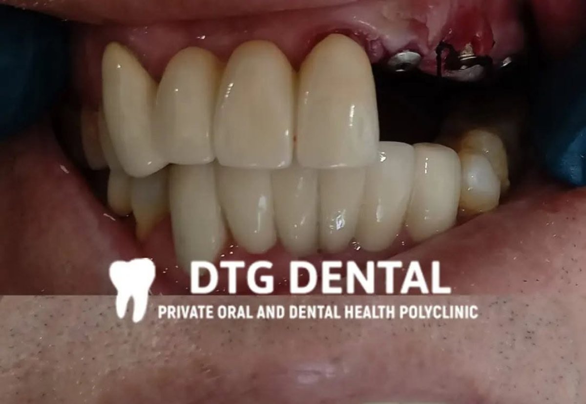 نتيجة زراعة الأسنان في عيادة DTG Dental – استعادة الأسنان وتحسين الابتسامة