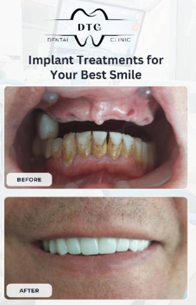 Before and after dental implant results at DTG Dental Clinic – restored smile transformation