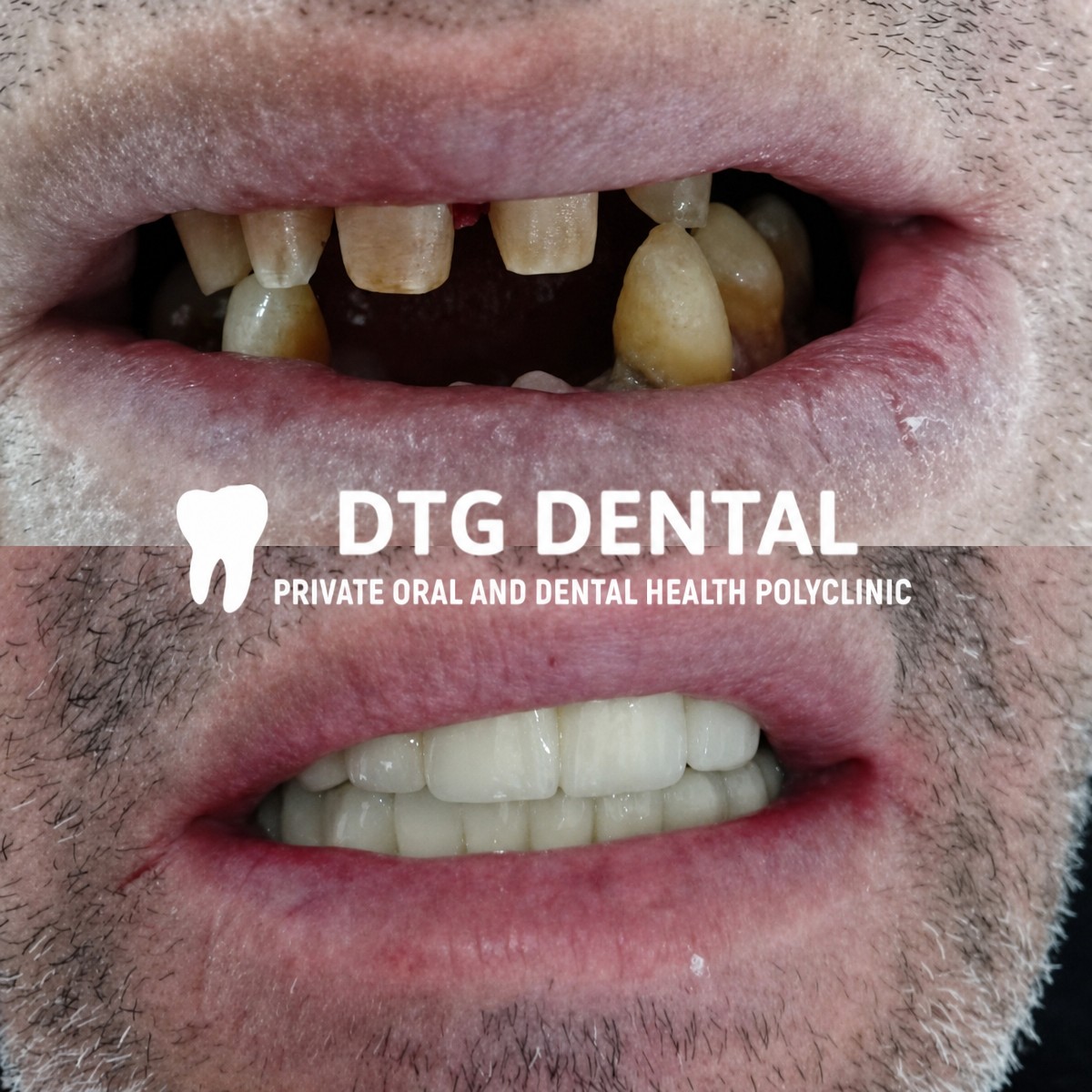 Before and after result of full-arch implant-fixed zirconia dentures at DTG Dental clinic