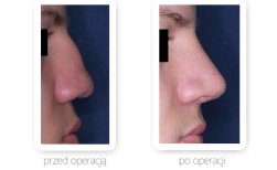 Fotos vor und nach Rhinoplastik (Nasenkorrektur) durch Dr. 