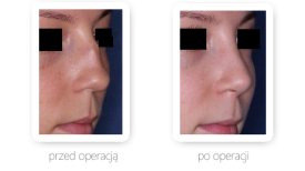 Fotos vor und nach Rhinoplastik (Nasenkorrektur) durch Dr. 