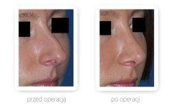 Fotos vor und nach Rhinoplastik (Nasenkorrektur) durch Dr. 