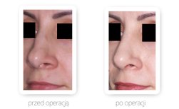 Fotos vor und nach Rhinoplastik (Nasenkorrektur) durch Dr. 
