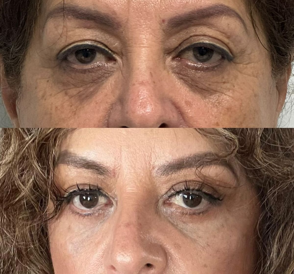 Before and after blepharoplasty results – eyelid correction with rejuvenated appearance