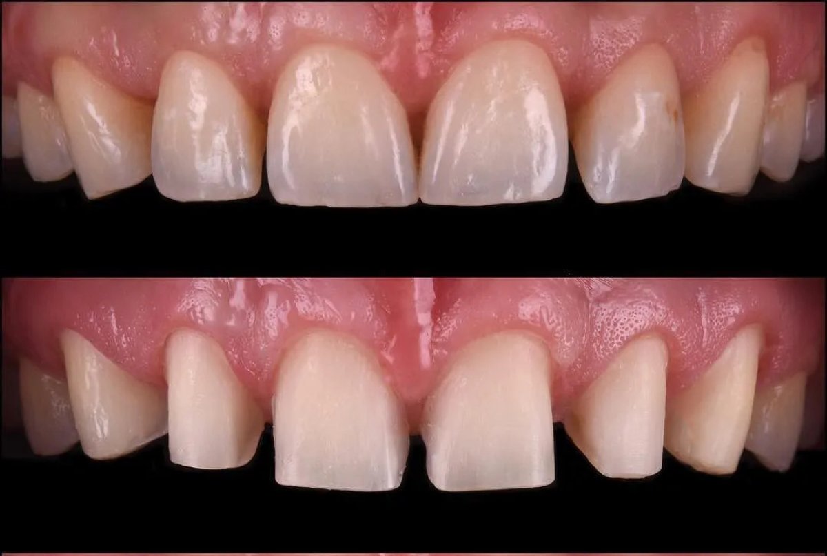 Before and after dental crown installation results – restored front teeth appearance