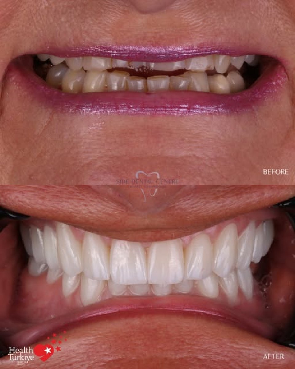 Smile makeover before and after results at Side Dental Centre – improved teeth alignment and color