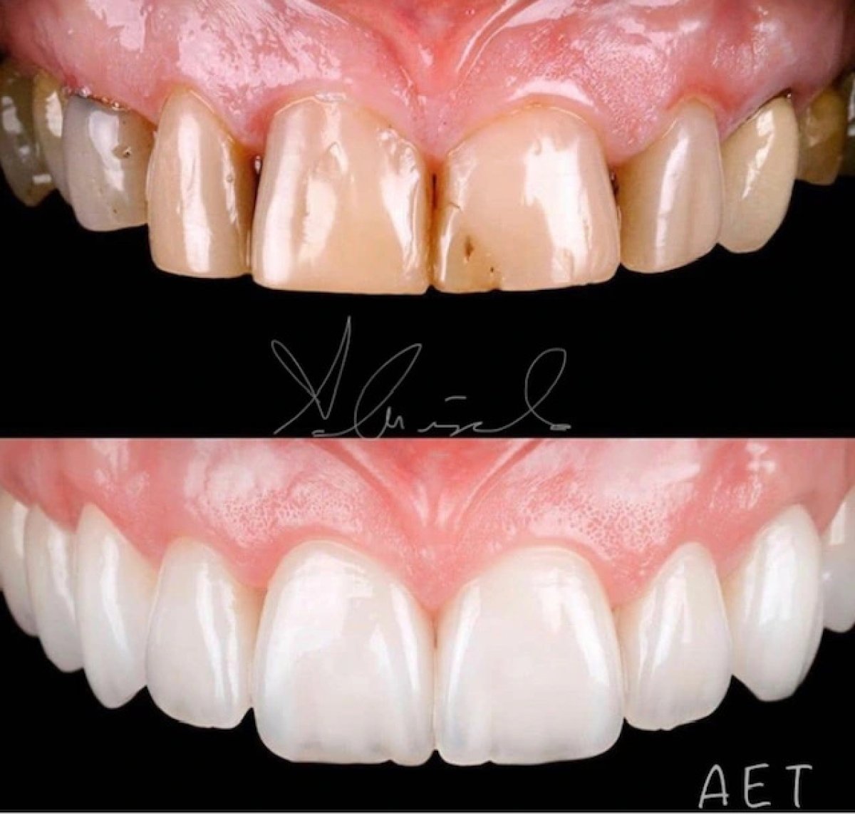 Before and after veneers result – smile makeover with whiter, even teeth at dental clinic