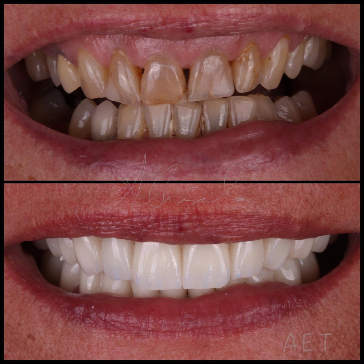 Before and after veneers result – smile transformation with whiter, even teeth