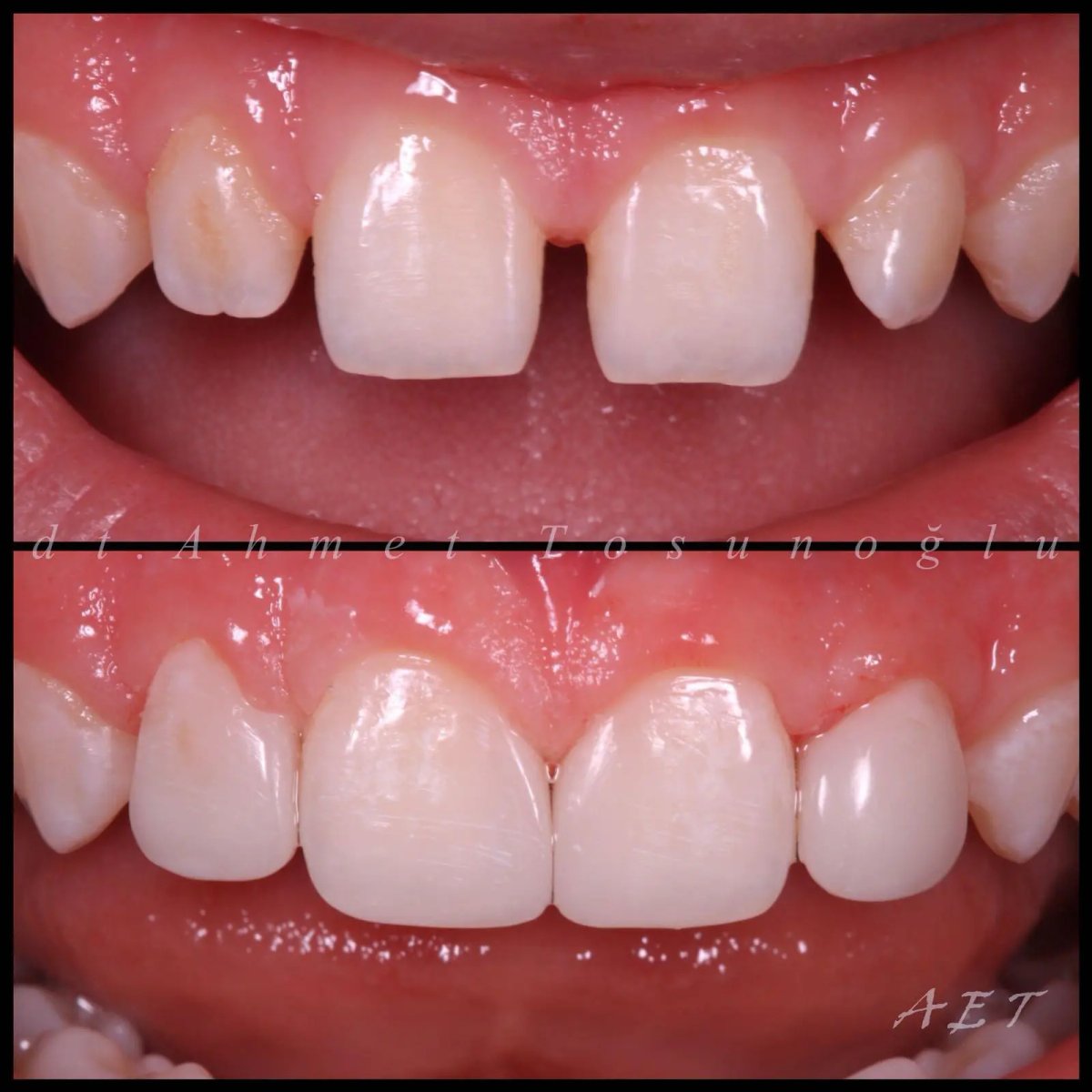 Before and after composite filling results – improved front teeth shape and smile aesthetics