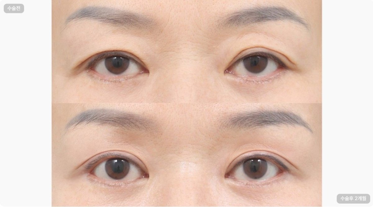 Before and after upper and lower eyelid surgery results at AB Plastic Surgery, rejuvenated eyes
