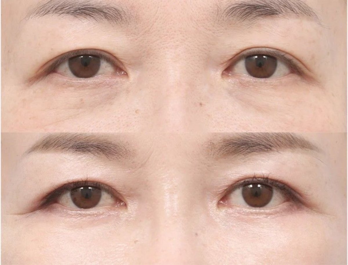 Результаты блефаропластики век до и после в AB Plastic Surgery, омоложение глаз