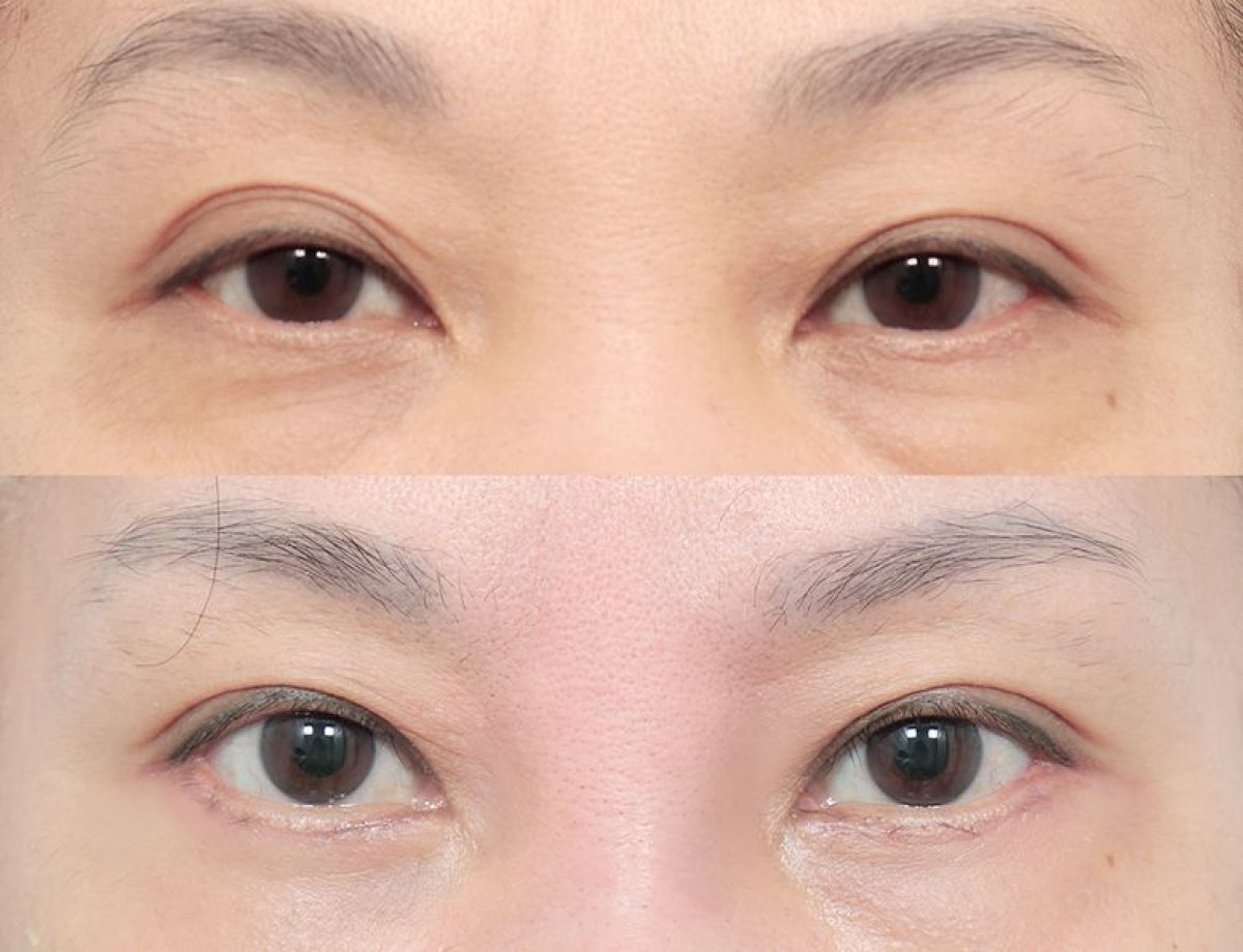 نتائج جراحة الجفون العلوية والسفلية قبل وبعد في AB Plastic Surgery، تجديد شباب العينين