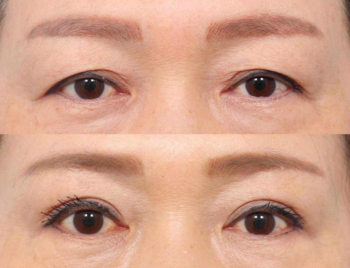 Before and after upper and lower eyelid surgery results at AB Plastic Surgery, rejuvenated eyes