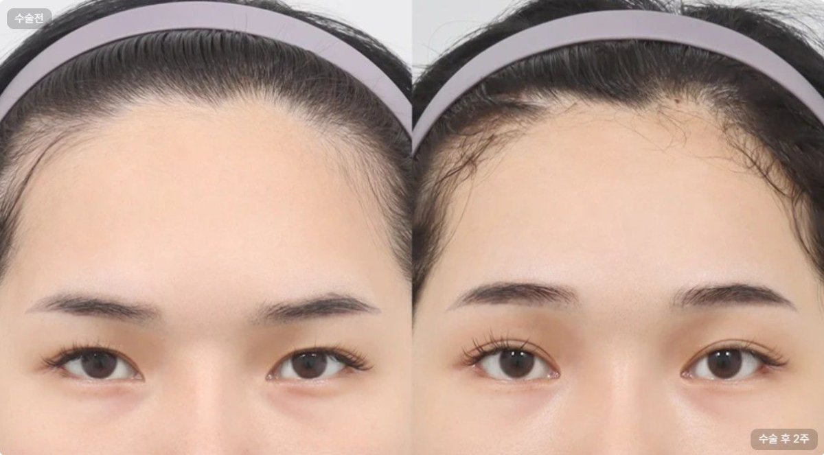 Before and after upper and lower eyelid surgery results at AB Plastic Surgery, refreshed eyes