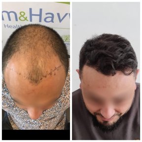 Unshaven DHI Hair Transplant with PRP — Lifetime Warranty & 4★ Hotel - photo 4