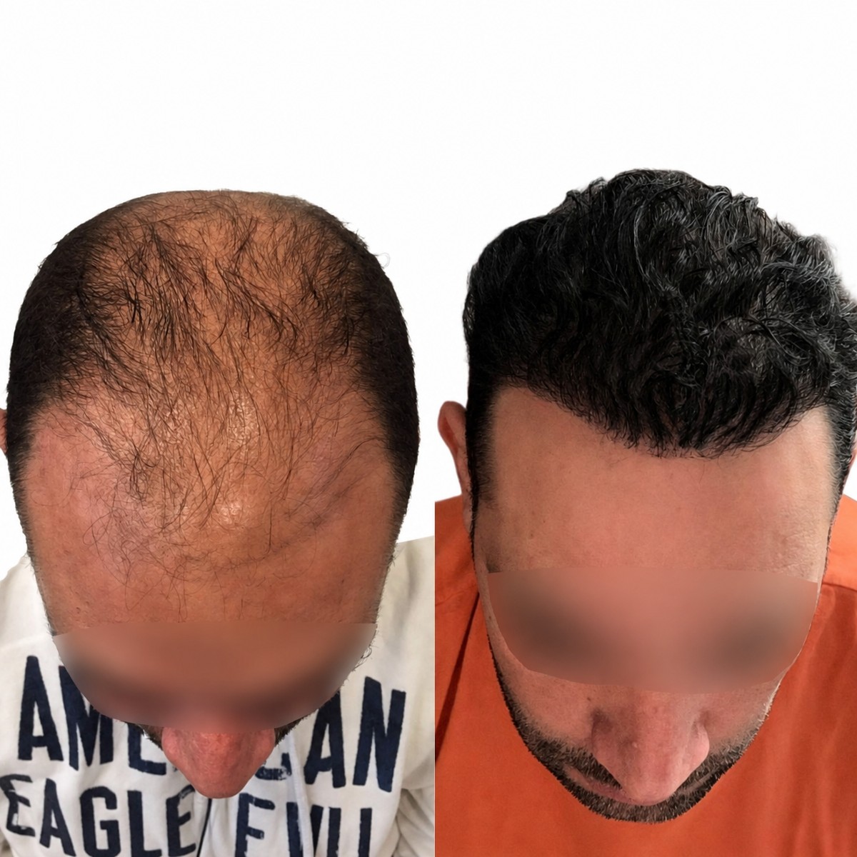 نتائج زراعة الشعر قبل وبعد في مركز آدم وحواء الطبي، استعادة خط الشعر
