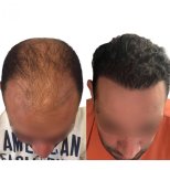 Hair transplant results by Dr. Dr Fuzun Erdogan - Patient’s before and after images Before and after Hair transplant photos by Dr. Dr Fuzun Erdogan