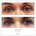 صور قبل وبعد تكبير الثدي للدكتور Zukowska Dorota