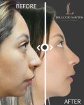 Fotos vor und nach Rhinoplastik (Nasenkorrektur) durch Dr. Lucio Santos Moyron