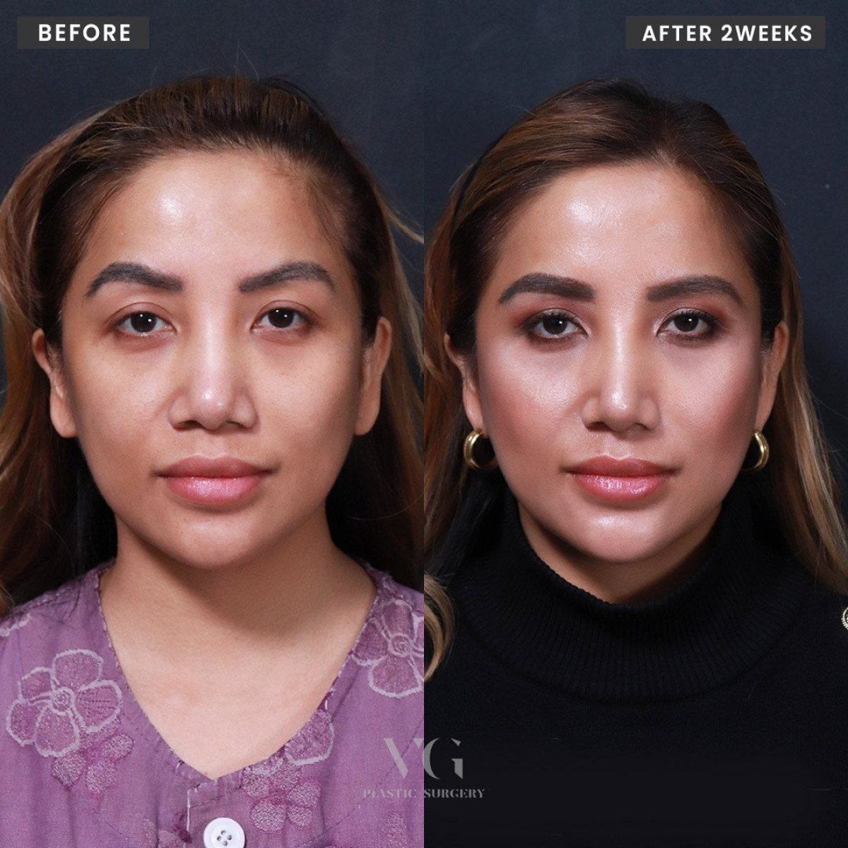 نتائج قبل وبعد عملية تصغير فتحات الأنف في VG Plastic Surgery وتحسن واضح لشكل الأنف