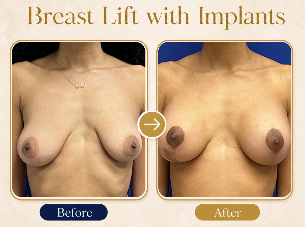 Before and after breast lift with implants results – enhanced breast shape and volume