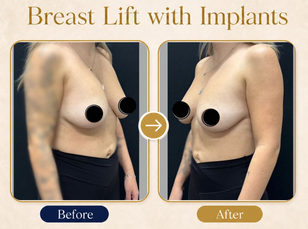 Before and after breast lift with implants results – improved breast shape and volume