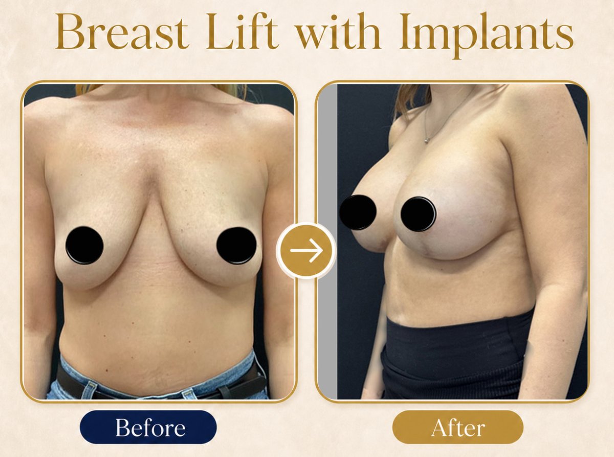Resultados antes y después de mastopexia con implantes – mejor forma y volumen mamario
