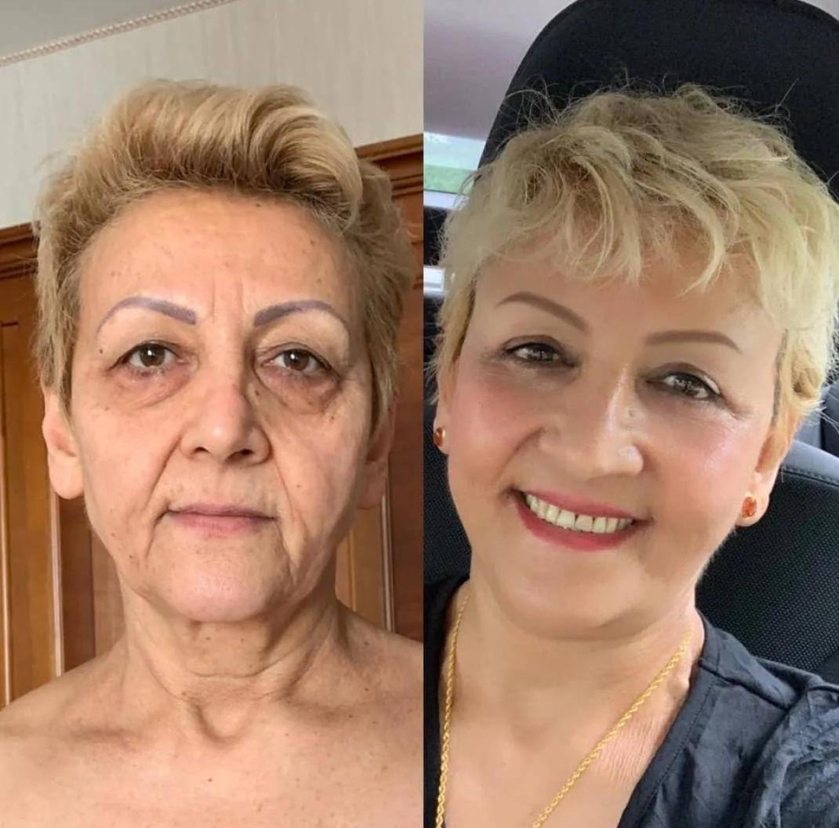 Resultados de lifting facial antes y después: rejuvenecimiento y piel más suave