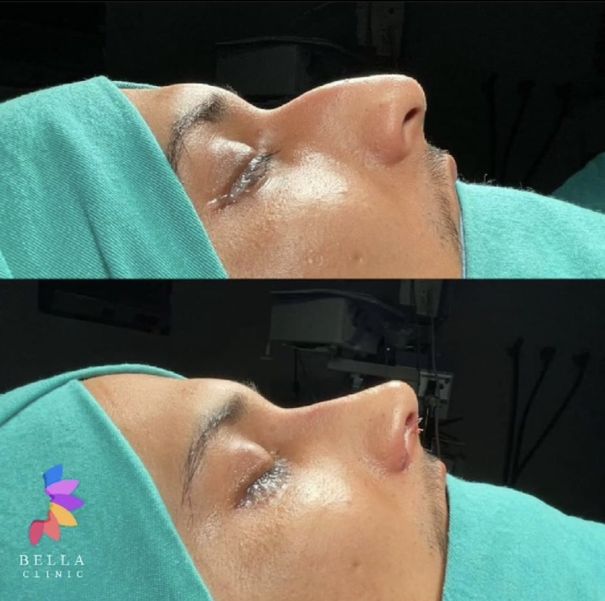 Результаты ринопластики до и после в Bella Clinic, улучшенная форма носа и профиль