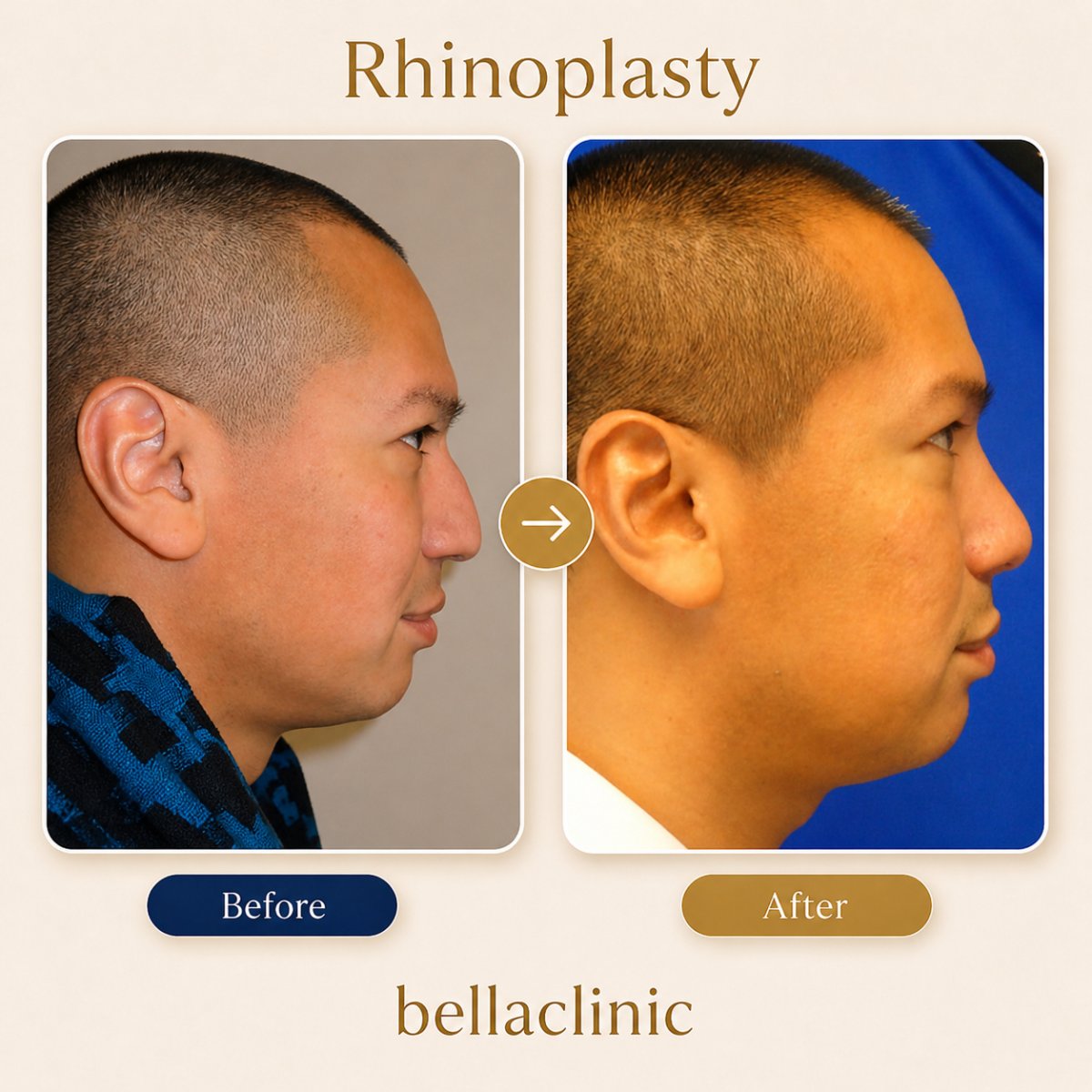 نتائج عملية تجميل الأنف قبل وبعد في bellaclinic، إعادة تشكيل الأنف لتحسين المظهر الجانبي
