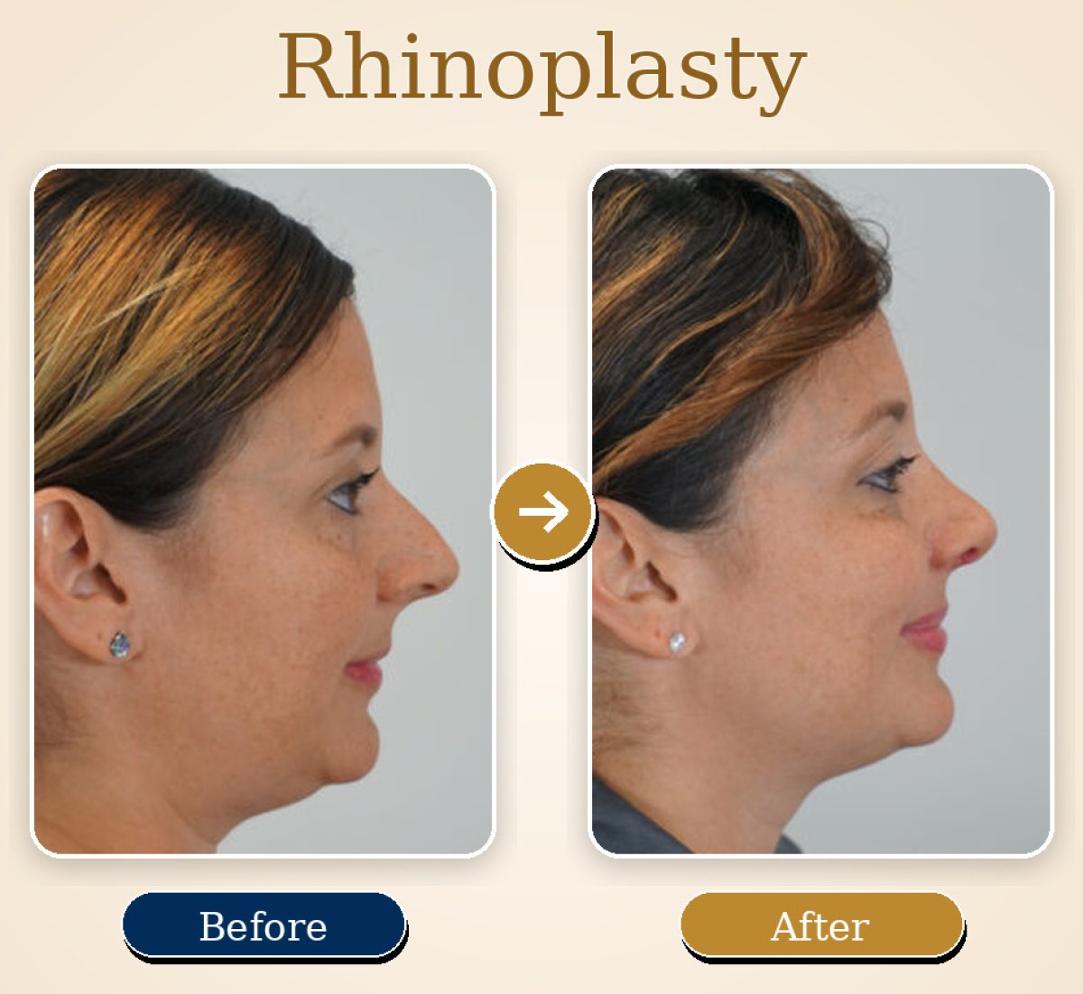 Before and after rhinoplasty results – improved nose shape and profile after surgery