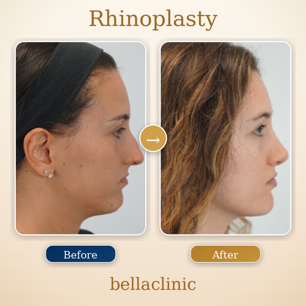 Resultados de rinoplastia antes y después en bellaclinic, perfil nasal natural