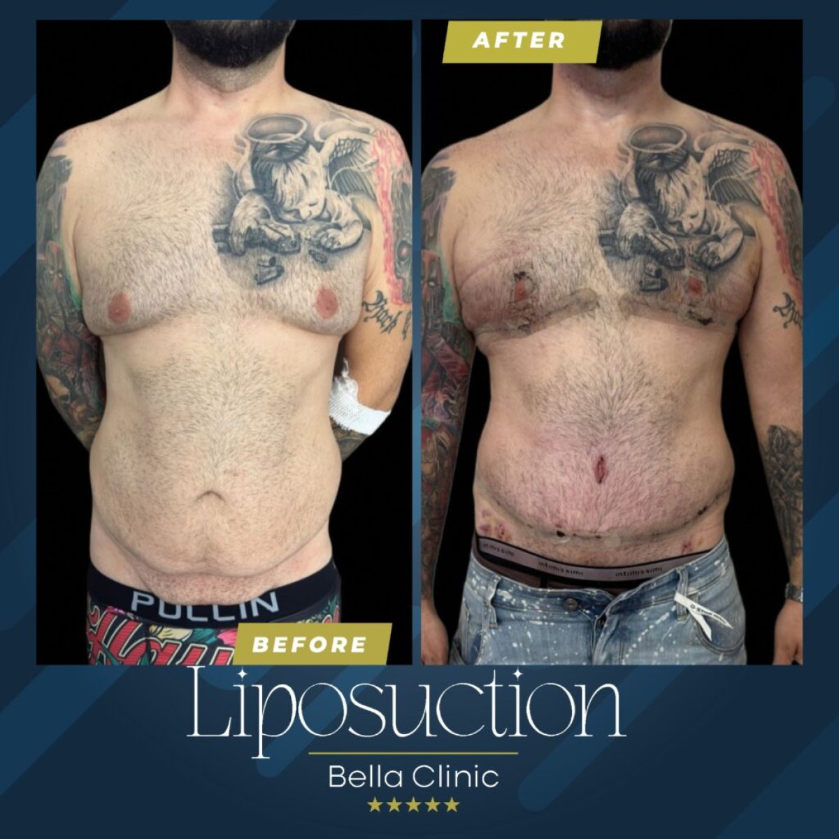 Resultados de liposucción antes y después en Bella Clinic, mejora visible del contorno corporal