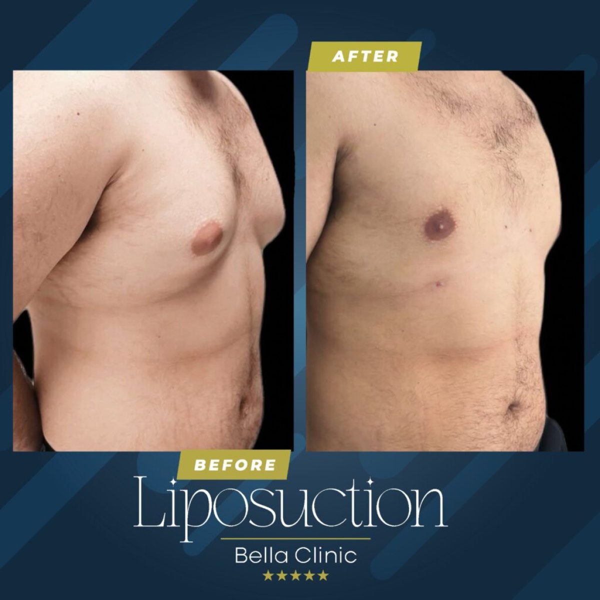 Before and after male chest liposuction results at Bella Clinic, improved body contour